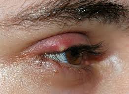 Ingrown Eyelash – Causes, Symptoms, and Treatment