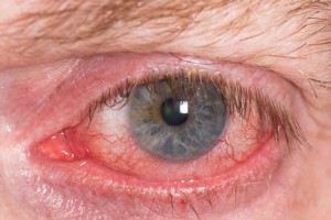What are eye disorders, their causes and symptoms