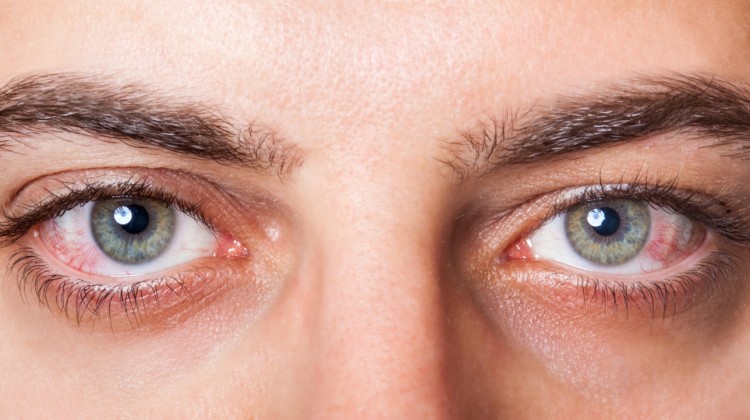 Eyelashes infections, their symptoms and treatments