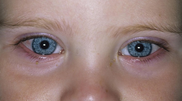 Common eye infections in newborns